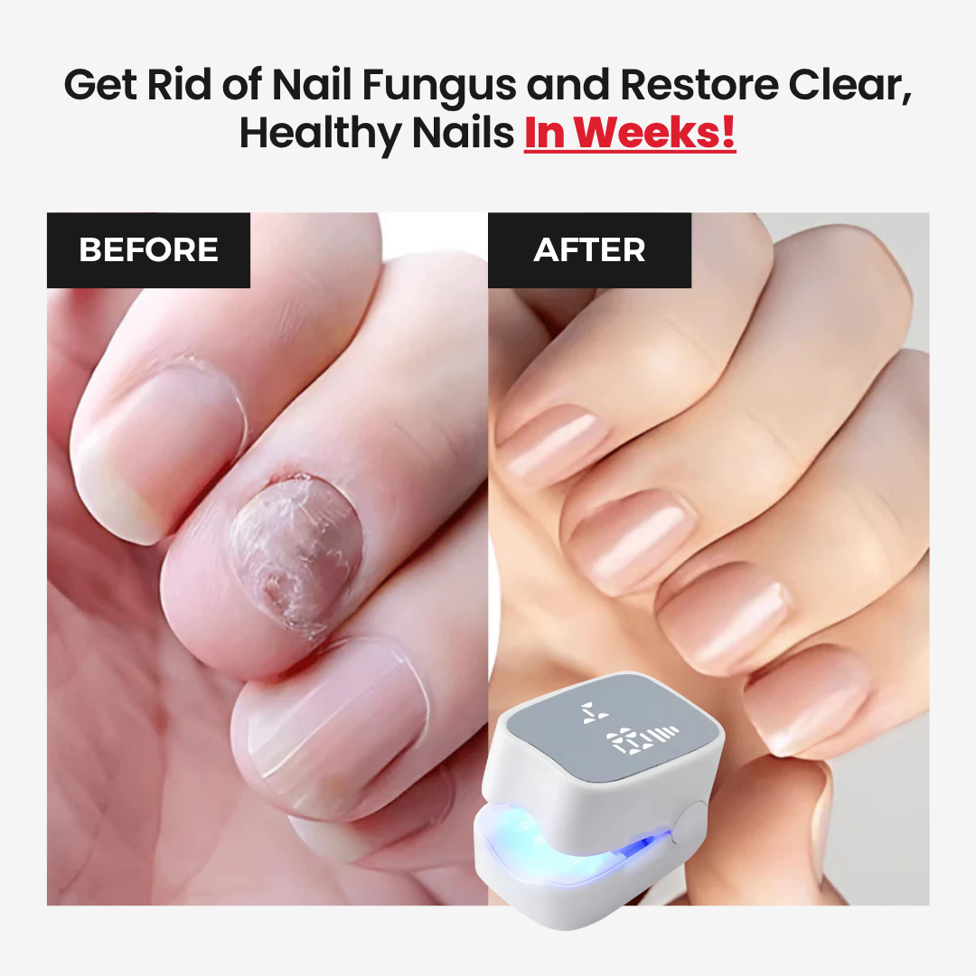NailCure Pro™ - Nail Fungus Laser Device