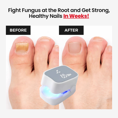 NailCure Pro™ - Nail Fungus Laser Device